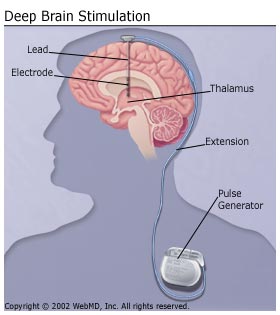 Parkinsons Disease Deep Brain Stimulation.jpg