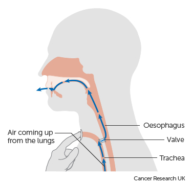 Trachea-oesophageal puncture.jpg